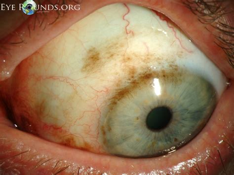 what is melanosis of the eye